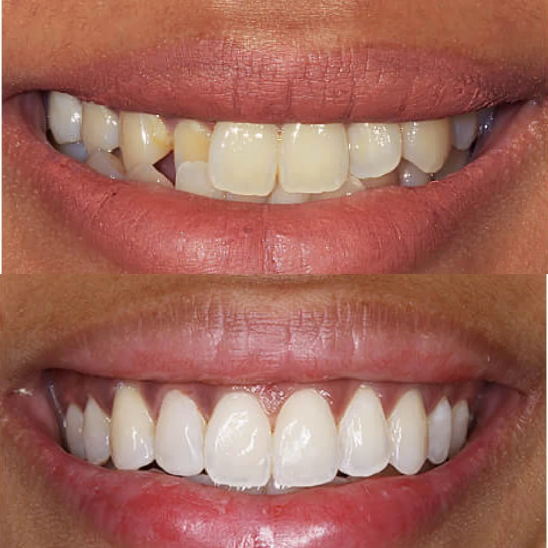 Uneven front teeth ad creative