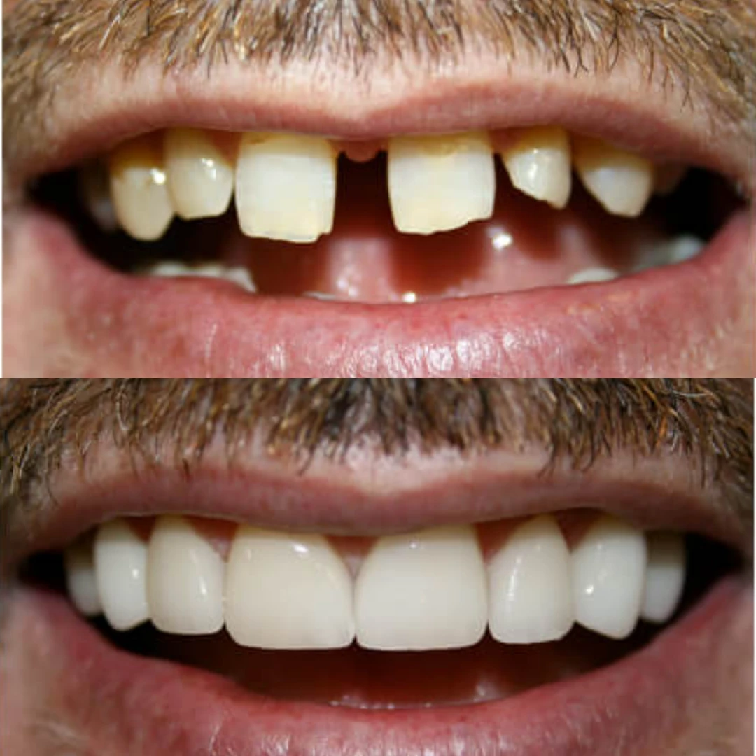 Missing or damaged front teeth ad creative
